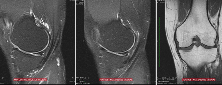 lésions-méniscales.jpg