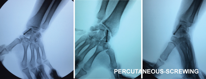 Percutaneous-screwing.jpg Percutaneous-screwing.jpg