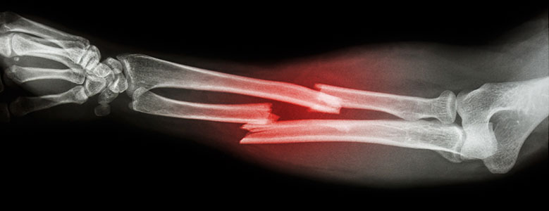 radios-de-fracture.jpg radios-de-fracture.jpg