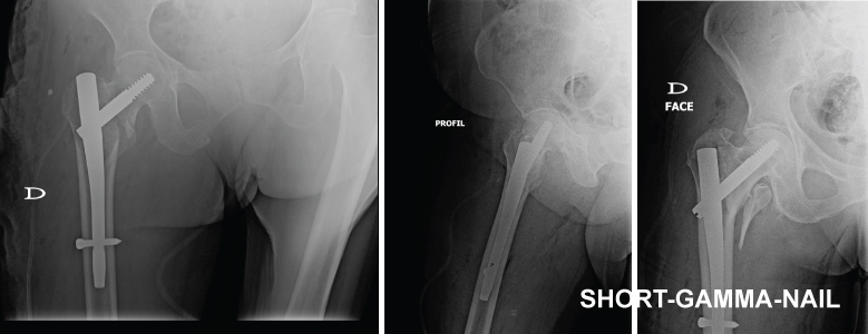 with bipolar hemi-arthroplasty